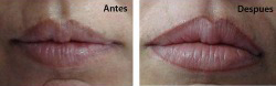 Micropigmentación en labios - Aquabells